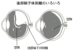 後部硝子体剥離のいろいろ