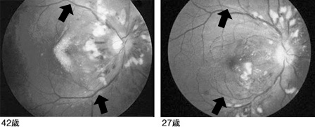 42歳男性と27歳男性の眼底写真例