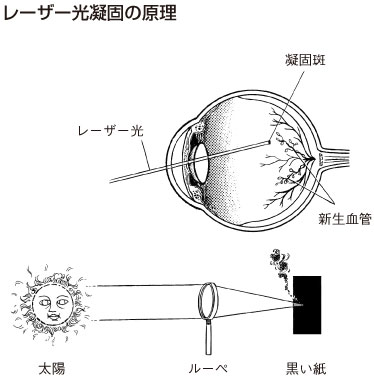 レーザー光凝固の原理