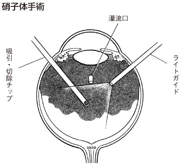 硝子体手術