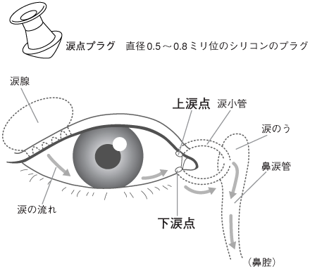 涙点プラグとは、直径0.5～0.8ミリ位のシリコンのプラグです。涙点プラグで涙点を閉じます