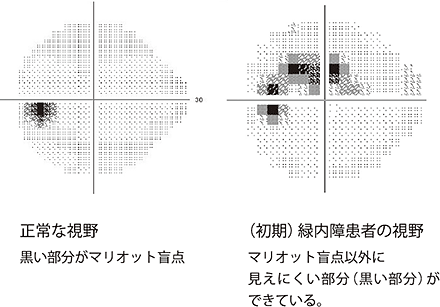 初期の緑内障患者の視野には、マリオット盲点以外に見えにくい部分ができます