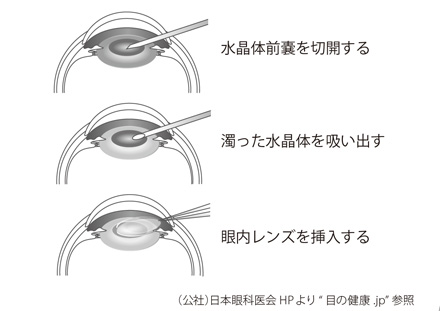 白内障の手術