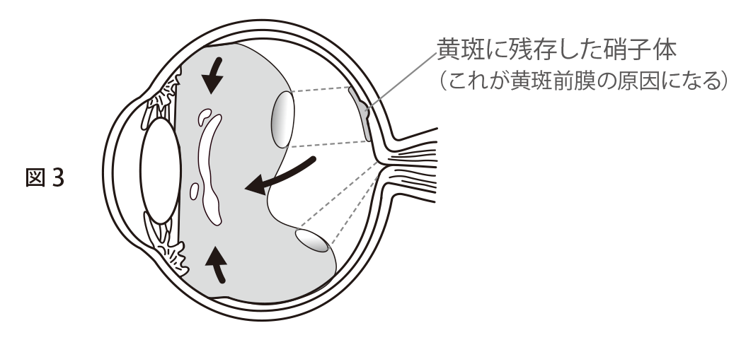 図3 黄斑に残存した硝子体(これが黄斑前膜の原因になる)