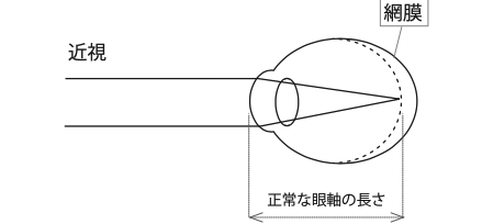 近視の説明